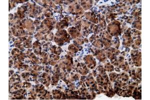 Immunohistochemical staining of paraffin-embedded Adenocarcinoma of Human colon tissue using anti-EPHX2 mouse monoclonal antibody. (EPHX2 anticorps)