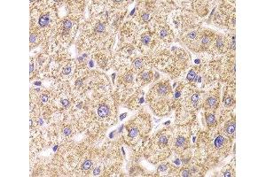 Immunohistochemistry of paraffin-embedded Human liver damage using ST3GAL3 Polyclonal Antibody at dilution of 1:100 (40x lens). (ST3GAL3 anticorps)