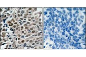Immunohistochemistry analysis of paraffin-embedded human breast carcinoma, using FKHRL1 (Phospho-Ser253) Antibody. (FOXO3 anticorps  (pSer253))