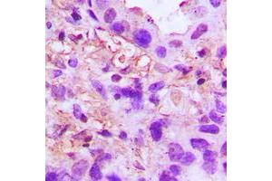 Immunohistochemical analysis of TSG6 staining in human lung cancer formalin fixed paraffin embedded tissue section.