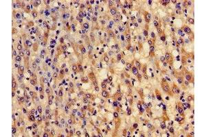 Immunohistochemistry of paraffin-embedded human liver cancer using ABIN7154002 at dilution of 1:100 (GCLM anticorps  (Regulatory Subunit))