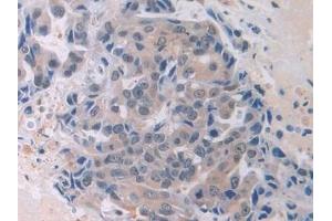 Detection of MAEA in Human Breast cancer Tissue using Polyclonal Antibody to Macrophage Erythroblast Attacher (MAEA)