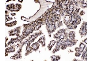 IHC testing of FFPE human renal cancer tissue with Purine nucleoside phosphorylase antibody at 1ug/ml. (PNP anticorps  (AA 161-189))