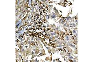 Immunohistochemistry of paraffin-embedded human liver cancer using [KO Validated]  Rabbit pAb (ABIN6133581 and ABIN6136917) at dilution of 1:100 (40x lens).