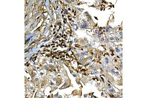 Immunohistochemistry of paraffin-embedded human liver cancer using [KO Validated]  Rabbit pAb (ABIN6133581 and ABIN6136917) at dilution of 1:100 (40x lens). (Annexin a1 anticorps)