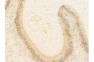 ABIN7097091 and ABIN7101158 at 1/100 staining human testicular cancer by IHC-P. (NCF1C anticorps)