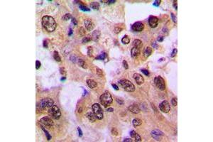 Immunohistochemical analysis of IKK beta (pS23) staining in human breast cancer formalin fixed paraffin embedded tissue section.