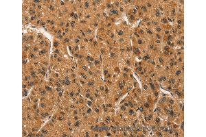 Immunohistochemistry of Human liver cancer using CCNT1 Polyclonal Antibody at dilution of 1:30