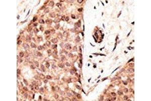 IHC analysis of FFPE human breast carcinoma tissue stained with the CDX2 antibody (CDX2 anticorps  (AA 1-30))
