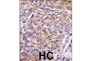 Formalin-fixed and paraffin-embedded human hepatocarcinoma tissue reacted with TAOK3 antibody , which was peroxidase-conjugated to the secondary antibody, followed by DAB staining. (TAO Kinase 3 anticorps  (C-Term))