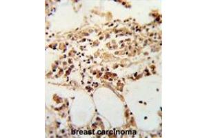 Formalin-fixed and paraffin-embedded human breast carcinoma reacted with TIMP3 Antibody (Center), which was peroxidase-conjugated to the secondary antibody, followed by DAB staining. (TIMP3 anticorps  (Middle Region))