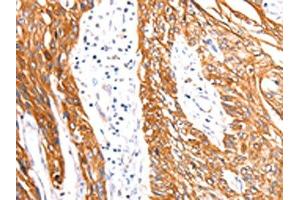 The image on the left is immunohistochemistry of paraffin-embedded Human esophagus cancer tissue using ABIN7192115(Rab3D Antibody) at dilution 1/27, on the right is treated with synthetic peptide. (RAB3D anticorps)