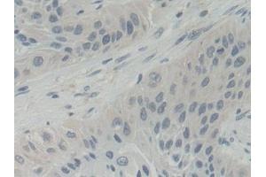 Detection of ABCB5 in Human Lung cancer Tissue using Polyclonal Antibody to ATP Binding Cassette Transporter B5 (ABCB5)