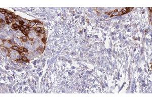 ABIN6273638 at 1/100 staining Human urothelial cancer tissue by IHC-P. (IL12RB1 anticorps  (Internal Region))