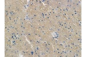 ABIN6256621 and ABIN6267264 at 1/100 staining human glioblastoma by IHC-P.