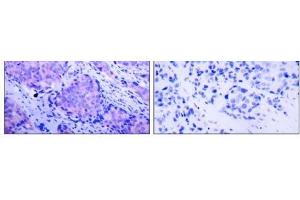 Immunohistochemical analysis of paraffin- embedded human breast carcinoma tissue using PDK1 (phospho-Ser241) antibody (E011005). (PDPK1 anticorps  (pSer241))
