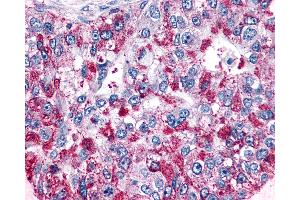 Anti-GPR4 antibody IHC of human Lung, Adenocarcinoma.