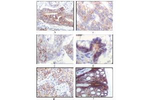Immunohistochemical analysis of paraffin-embedded human gastric adenocarcinoma(A), golon adenocarcinoma (B), endometrial carcinoma (uterus) (C), ovary adenocarcinoma (D), lung squamous cell carcinoma (E), stomach epithelium mucosae (F), showing membrane localization using IGF1R mouse mAb with DAB staining. (IGF1R anticorps)