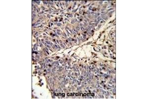 Formalin-fixed and paraffin-embedded human lung carcinoma reacted with CFL1 Antibody (N-term), which was peroxidase-conjugated to the secondary antibody, followed by DAB staining. (Cofilin anticorps  (N-Term))