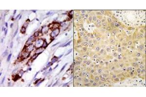 (LEFT)Formalin-fixed and paraffin-embedded human cancer tissue reacted with the primary antibody, which was peroxidase-conjugated to the secondary antibody, followed by DAB staining.
