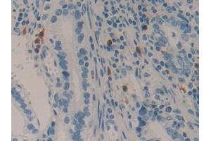 IHC-P analysis of Human Stomach cancer Tissue, with DAB staining. (LAMC2 anticorps  (AA 416-602))