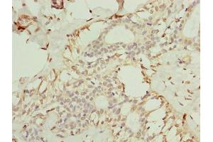 Immunohistochemistry of paraffin-embedded human breast cancer using ABIN7173079 at dilution of 1:100 (TMEM154 anticorps  (AA 97-183))