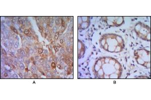 Immunohistochemical analysis of paraffin-embedded human lung cancer (A), colon cancer (B) using ST13 mouse mAb with DAB staining. (HSC70 Interacting Protein HIP anticorps)