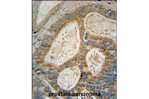 INSIG1 Antibody immunohistochemistry analysis in formalin fixed and paraffin embedded human prostate carcinoma followed by peroxidase conjugation of the secondary antibody and DAB staining. (INSIG1 anticorps  (N-Term))