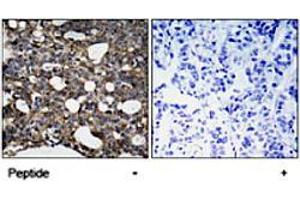 Immunohistochemical analysis of paraffin-embedded human breast carcinoma tissue using GJA1 (phospho S367) polyclonal antibody . (Connexin 43/GJA1 anticorps  (pSer367))