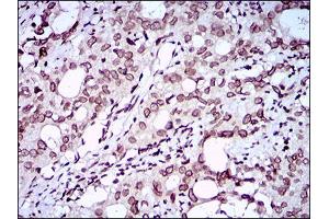 Immunohistochemical analysis of paraffin-embedded cervical cancer tissues using ZEB1 mouse mAb with DAB staining. (ZEB1 anticorps  (AA 967-1108))