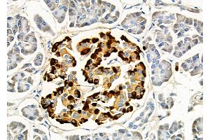 ABIN6257133 and ABIN6275805 at 1/100 staining Human pancreatic cancer and adjacent nomal tissues by IHC-P. (Topoisomerase I anticorps  (Internal Region))