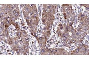 ABIN6276659 at 1/100 staining Human liver cancer tissue by IHC-P. (CD44 anticorps  (Internal Region))