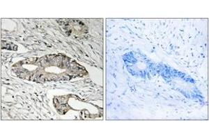 Immunohistochemistry analysis of paraffin-embedded human colon carcinoma tissue, using EPN3 Antibody. (EPN3 anticorps  (AA 401-450))