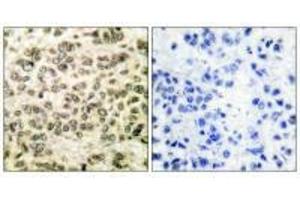 Immunohistochemical analysis of paraffin-embedded human breast carcinoma tissue using HDAC3 antibody. (HDAC3 anticorps  (C-Term))