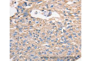 Immunohistochemistry of Human esophagus cancer using MVP Polyclonal Antibody at dilution of 1:40 (MVP anticorps)