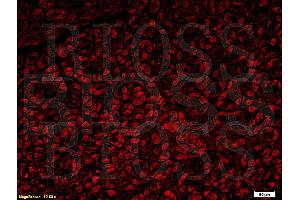 Formalin-fixed and paraffin embedded human gastric carcinoma with Anti-Fascin1 Polyclonal Antibody, Unconjugated (ABIN728293) at 1:300, followed by conjugation to the secondary antibody Goat Anti-Rabbit IgG, PE conjugated used at 1:200 dilution for 40 minutes at 37°C.