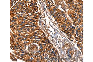 Immunohistochemistry of Human lung cancer using LGALS8 Polyclonal Antibody at dilution of 1:50 (LGALS8 anticorps)