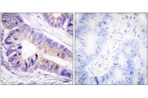 Immunohistochemistry analysis of paraffin-embedded human colon carcinoma tissue, using 14-3-3 zeta/delta (Ab-232) Antibody.