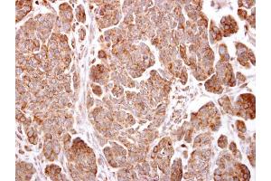 IHC-P Image TMEM59 antibody detects TMEM59 protein at cytosol on human ovarian carcinoma by immunohistochemical analysis.