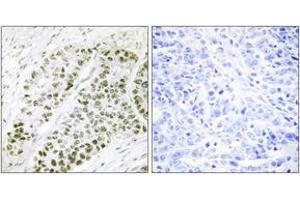 Immunohistochemistry analysis of paraffin-embedded human lung carcinoma, using ATF2 (Phospho-Ser480) Antibody.