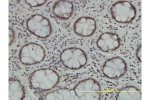 Immunoperoxidase of monoclonal antibody to TLK2 on formalin-fixed paraffin-embedded human colon tissue. (TLK2 anticorps  (AA 1-126))