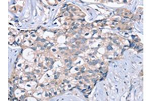 The image on the left is immunohistochemistry of paraffin-embedded Human breast cancer tissue using ABIN7129969(KCNQ5 Antibody) at dilution 1/60, on the right is treated with fusion protein. (KCNQ5 anticorps)