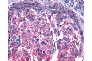 Anti-BOB / GPR15 antibody IHC of human Skin, Melanoma.