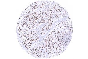 Urinary bladder Muscle invasive urothelial carcinoma with moderate to strong GATA3 immunostaining of tumor cells