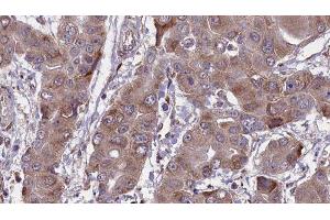 ABIN6276678 at 1/100 staining Human liver cancer tissue by IHC-P.