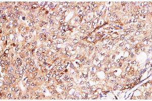 Immunohistochemistry of paraffin-embedded Human breast cancer using S100A11 Polyclonal Antibody at dilution of 1:200 (S100A11 anticorps)