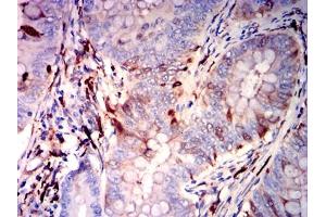 Immunohistochemical analysis of paraffin-embedded rectal cancer tissues using GSN mouse mAb with DAB staining. (Gelsolin anticorps)