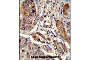 Formalin-fixed and paraffin-embedded human hepatocarcinoma reacted with EBP Antibody (N-term), which was peroxidase-conjugated to the secondary antibody, followed by DAB staining. (EBP anticorps  (N-Term))
