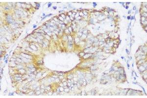 Immunohistochemistry of paraffin-embedded Human colon carcinoma using ECH1 Polyclonal Antibody at dilution of 1:150 (40x lens).