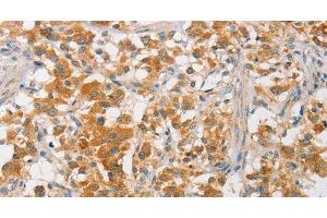 Immunohistochemistry of paraffin-embedded Human thyroid cancer using ARMCX3 Polyclonal Antibody at dilution of 1:40 (ARMCX3 anticorps)